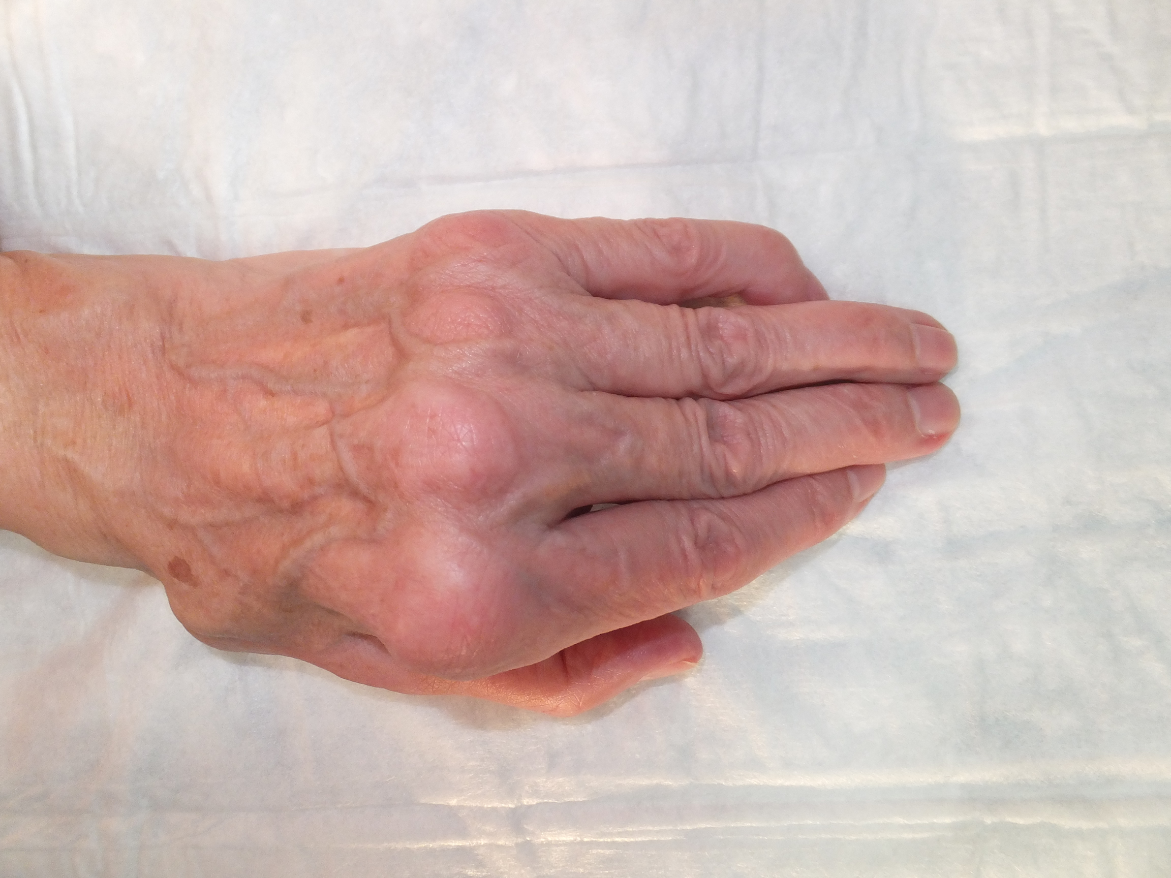 Wrist involvement in rheumatoid arthritis