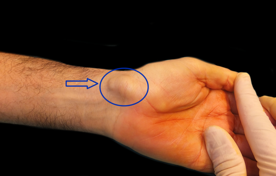 I have a bump on my wrist: the synovial cyst or ganglion