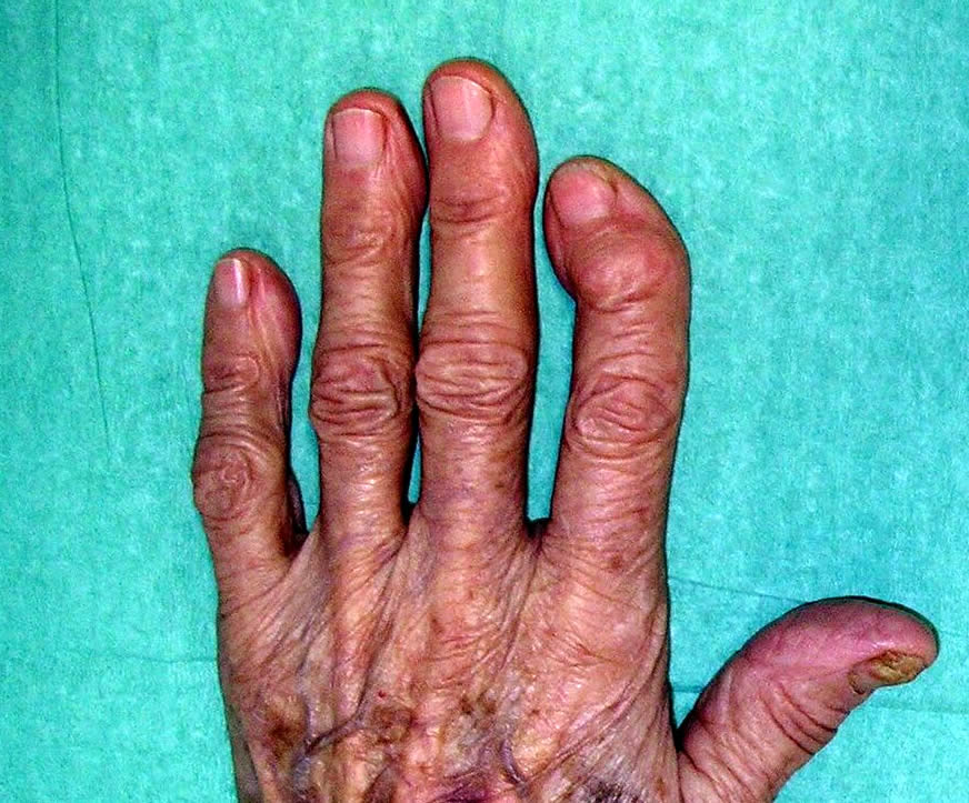 Osteoarthritis of the fingers