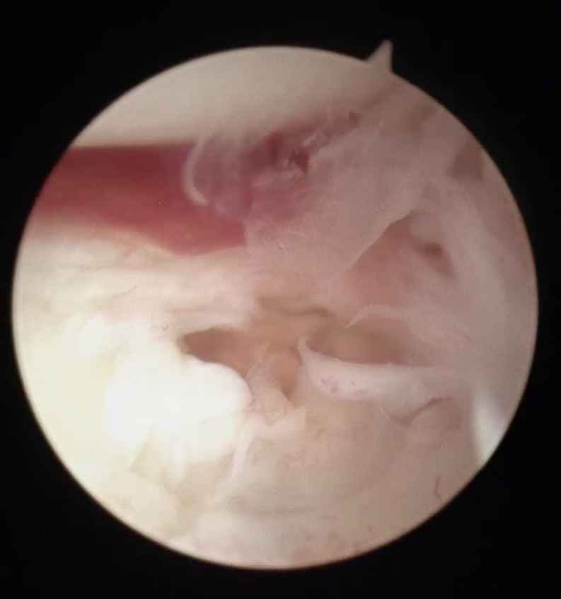 Tengo la “muñeca abierta”: Las lesiones de los ligamentos del carpo