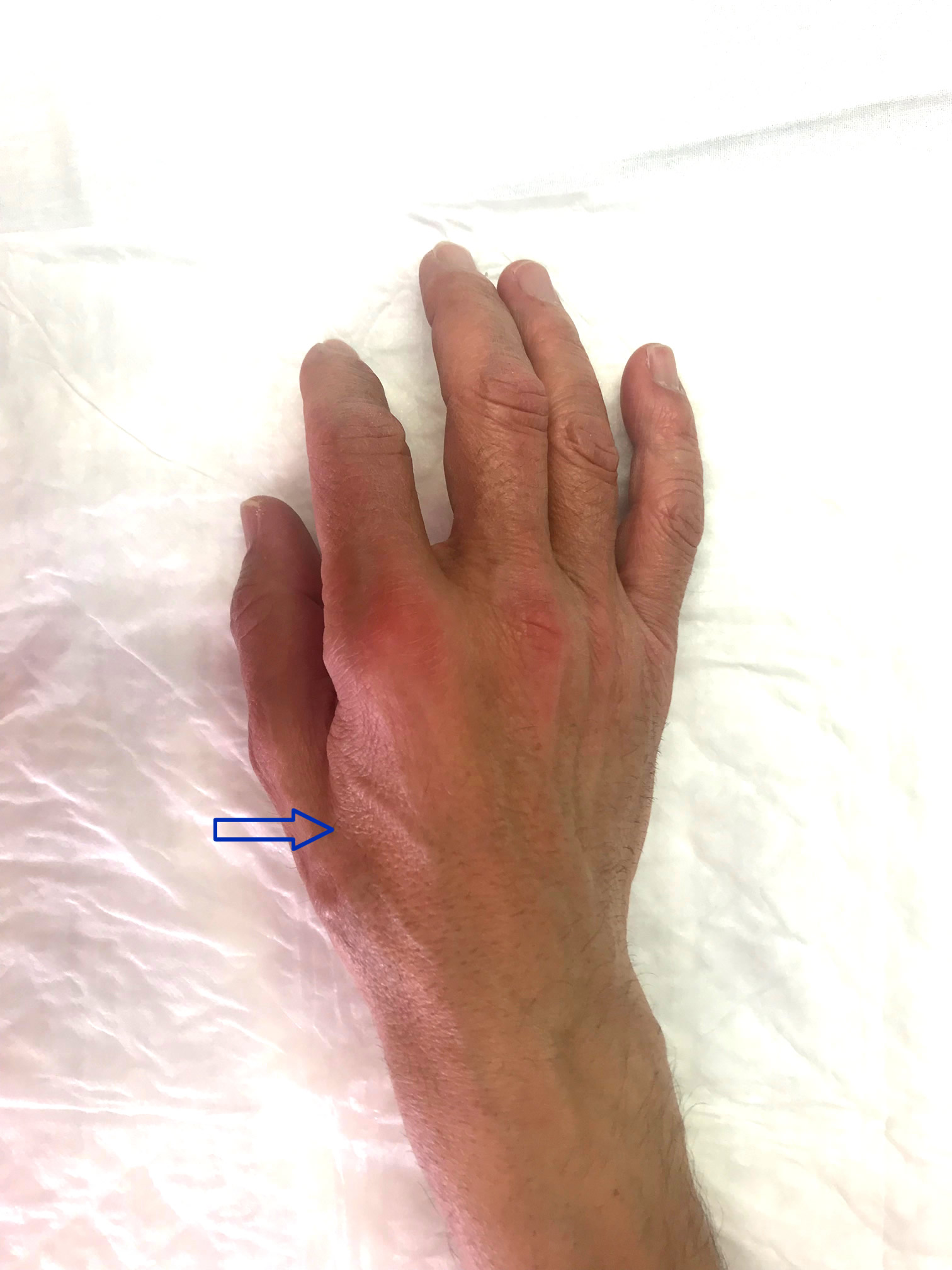 Frotar espíritu sitio Se me duerme el dedo meñique: La compresión del nervio cubital en el codo