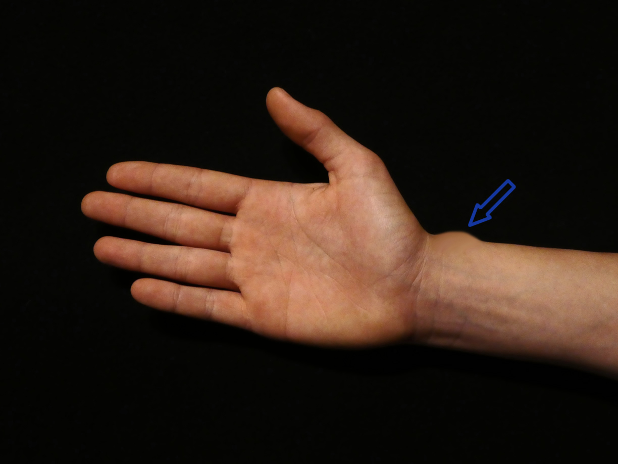 De Quervain's tendonitis