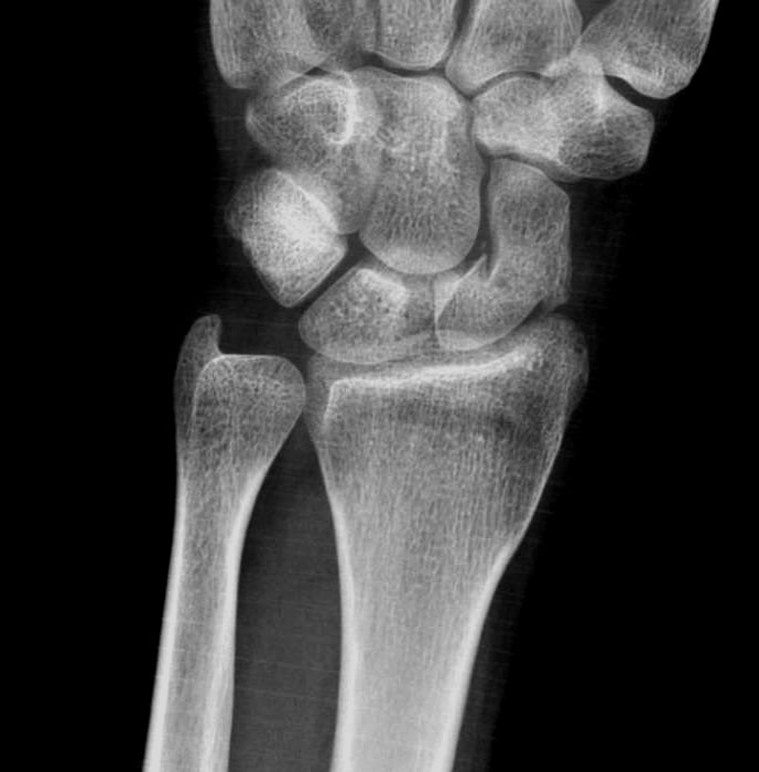 The wrist scaphoid fracture