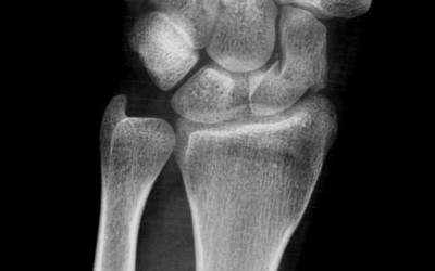 La fractura de l'escafoide del canell