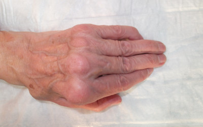 L'afectació del canell en l'Artritis Reumatoide