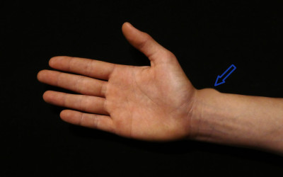 El dit en resort i la tendinitis de De Quervain