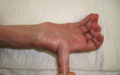 La hiperlaxitut lligamentosa causa de dolor a les mans dels músics