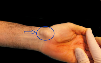 M'ha sortit un bony al canell: El quist sinovial o ganglió.