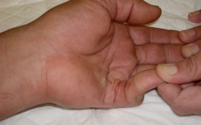 La malaltia de Dupuytren