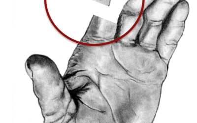 Com actuar en cas de trobar-se un ferit amb una amputació?