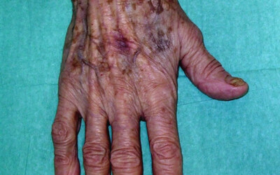 Artrosi de canell i mà