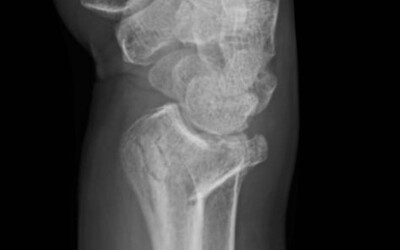 La fractura de canell. Fractura de Colles.