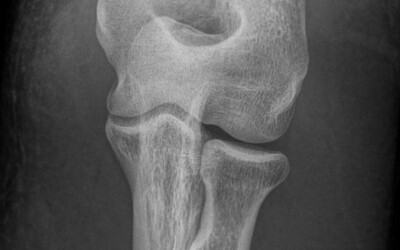 El colze de golfista o epitrocleitis