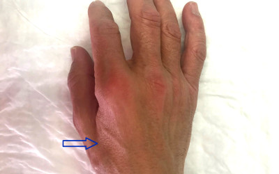 Se me dorm el dit petit de la mà: La compressió del nervi cubital en el colze