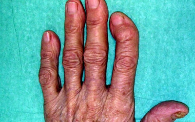 L'artrosi dels dits de la mà