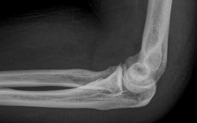 El colze de tennista o epicondilitis