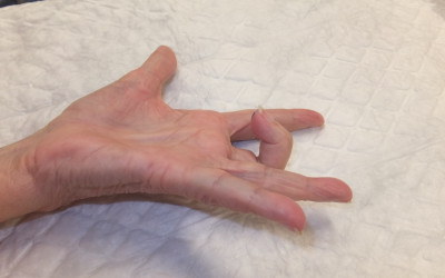 El dit en ressort o dit en molla