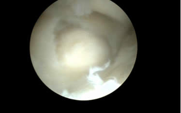 Tinc el “canell obert”: Les lesions dels lligaments del carp