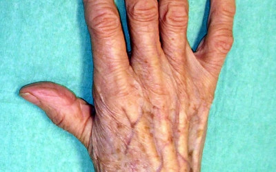 Artrosi de la base del polze: la Rizartrosi