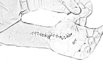 Instruccions postoperatòries en Cirurgia de Mà