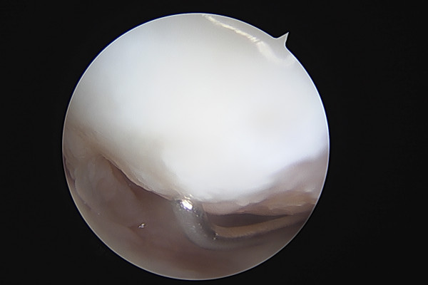 Wrist and Hand Arthroscopy: Minimally Invasive Surgery for More Precise Diagnosis and Treatment
